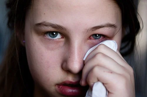 Người phụ nữ bị loét giác mạc khi tự ý mua thuốc điều trị đau mắt đỏ