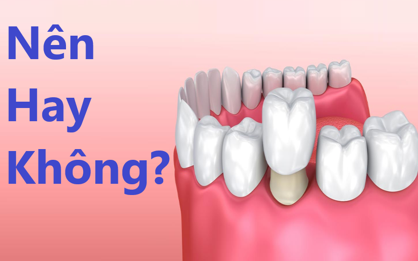 Chuyên gia giải đáp: Có nên bọc răng sứ không?