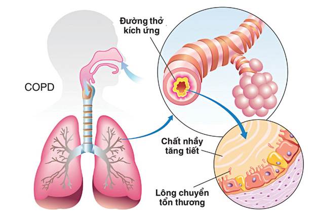 Chế độ sinh hoạt của bệnh nhân mắc phổi tắc nghẽn mãn tính COPD là gì?