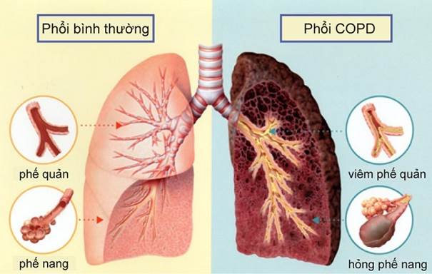 Giải độc phổi có tác dụng gì với bệnh phổi tắc nghẽn mãn tính COPD
