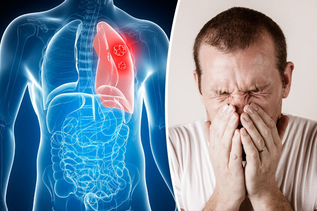 Ho khan hoặc ho có đờm là một trong những biểu hiện sớm của ung thư phổi