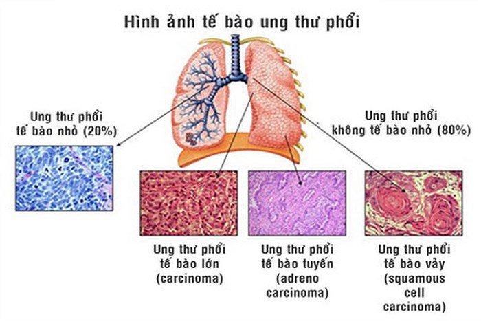 Phân loại ung thư phổi