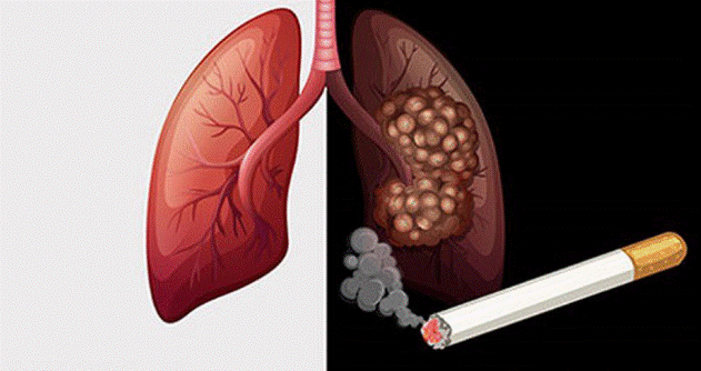 Hút thuốc lá là căn nguyên dẫn tới bệnh COPD