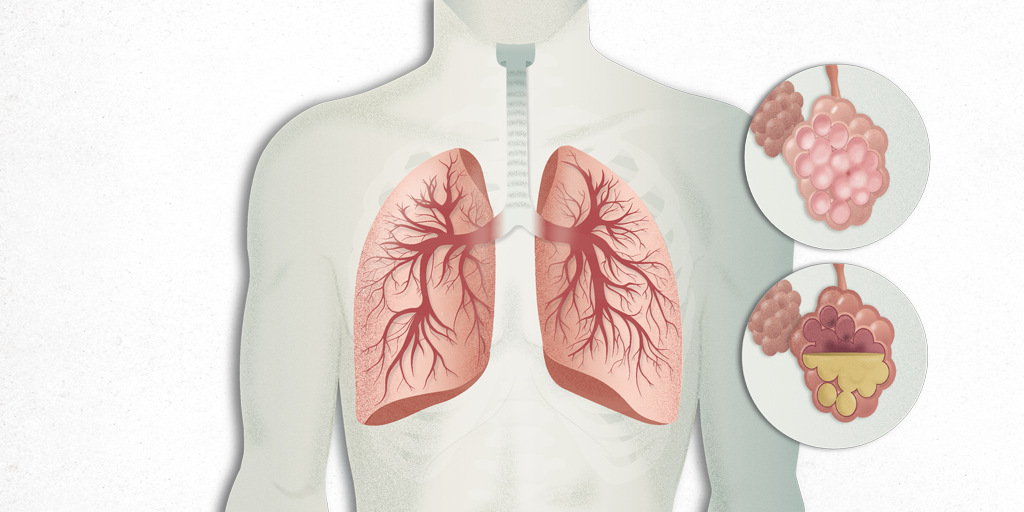 Viêm phổi là tình trạng đông đặc nhu mô phổi