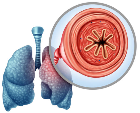 Phế quản của người bệnh COPD bị hẹp lại