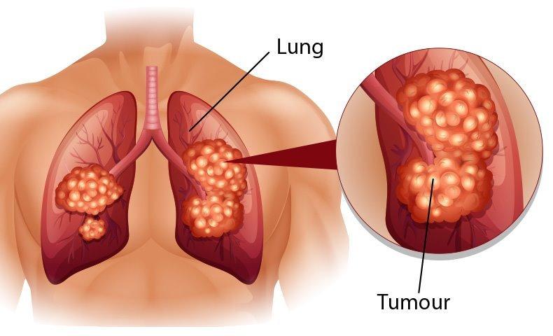 Khó thở thường xuất hiện ở giai đoạn cuối của ung thư phổi