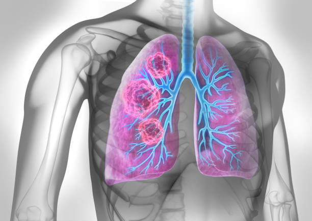  Người bị viêm phế quản mãn tính có nguy cơ cao mắc ung thư phổi