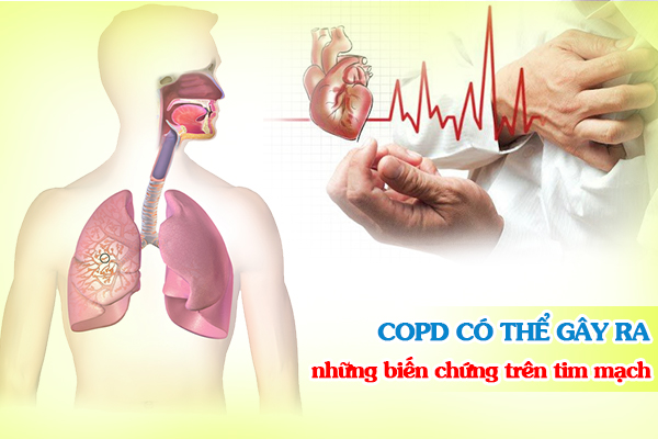 COPD có thể gây ra những biến chứng trên tim mạch.
