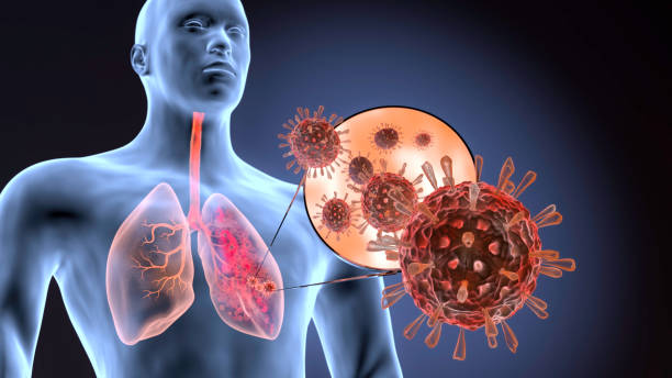 Nhiễm độc phổi là nguyên nhân gốc gây bệnh viêm phế quản mạn tính