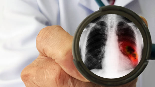 Bệnh phổi tắc nghẽn mãn tính có thể gây ung thư phổi