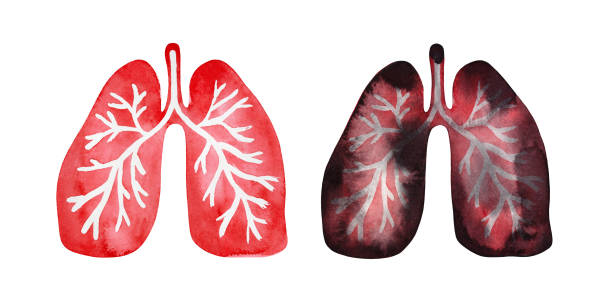 Nhiễm độc phổi làm tăng tần suất và mức độ đợt cấp COPD