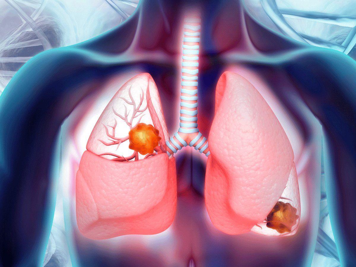 Bệnh bụi phổi amiăng có thể tiến triển sang bệnh ung thư phổi