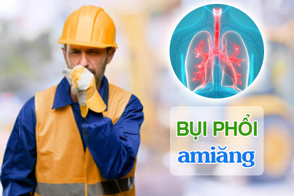 Bệnh bụi phổi amiăng là gì?