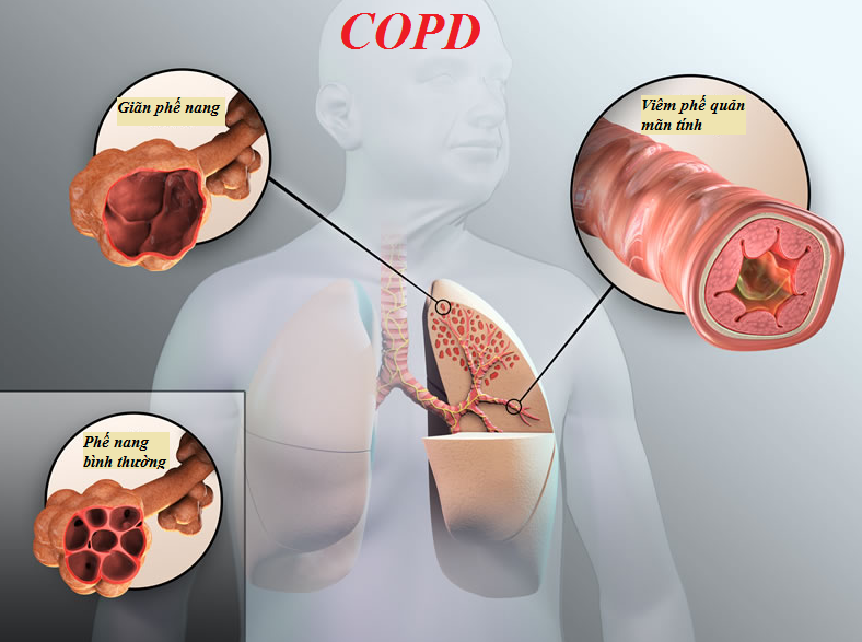 COPD là gì?