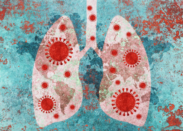 Viêm phổi thường do vi khuẩn, virus nấm gây ra