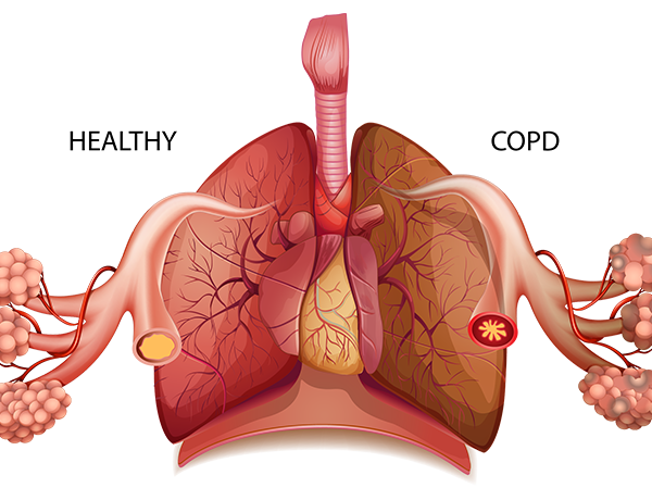 Những tác nhân làm tăng nguy cơ xuất hiện biến chứng COPD