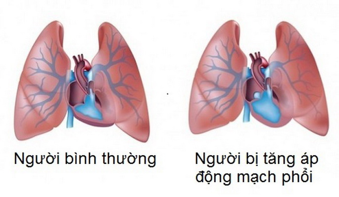Biến chứng tăng áp động mạch phổi