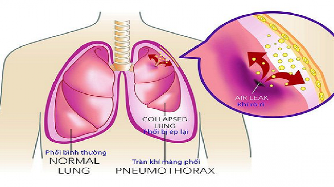 Biến chứng tràn khí màng phổi