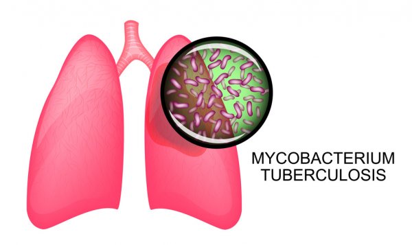 Lao phổi là bệnh do vi khuẩn Mycobacterium tuberculosis gây  nên ở phổi của người bệnh