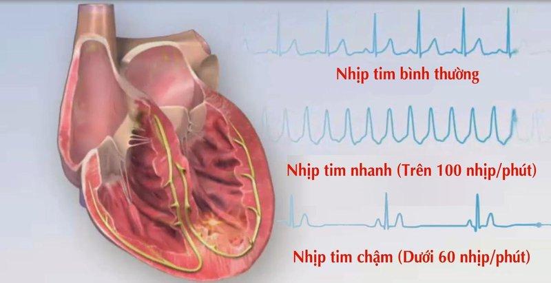 Bệnh nhân COPD cũng có nguy cơ gặp phải tình trạng loạn nhịp tim.
