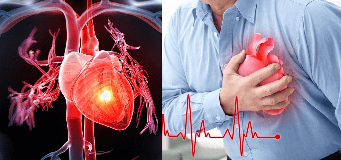 Cảnh báo hai biến chứng tim mạch nguy hiểm ở người bệnh phổi tắc nghẽn mạn tính