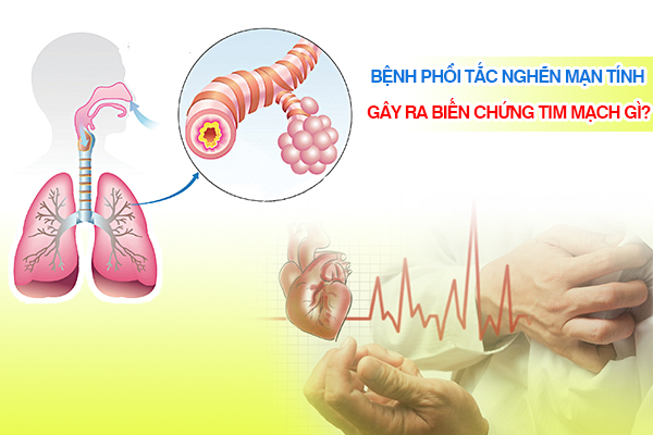 Bệnh phổi tắc nghẽn mạn tính gây ra biến chứng tim mạch gì?