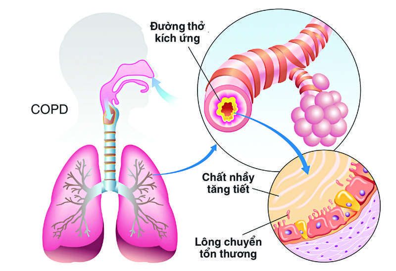 Bệnh phổi tắc nghẽn mãn tính gây ra triệu chứng ho khó thở tái phát liên tục không dứt