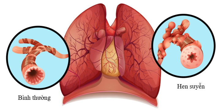 Hen suyễn gây ra triệu chứng ho khó thở tái phát không dứt