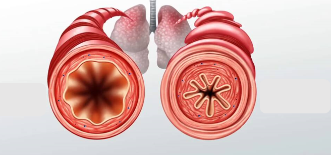 Viêm phế quản mãn tính- Bệnh lý đường hô hấp gây triệu chứng ho khó thở