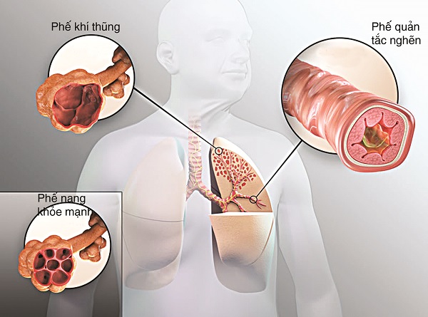 Những tổn thương tại đường hô hấp trong bệnh lý COPD