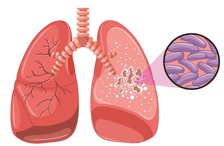 Thuốc bổ phổi nào giúp ngăn ngừa bệnh lao tái phát trở lại?