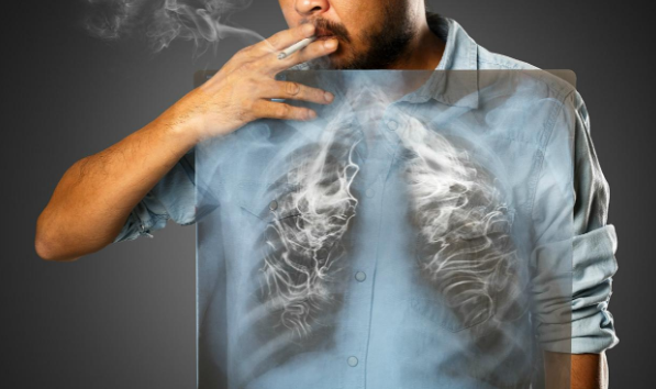 Biện pháp bảo vệ phổi của người hút thuốc lá trước nguy cơ bệnh tật