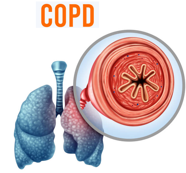 Nhiễm độc phổi là khởi nguồn của bệnh phổi tắc nghẽn mạn tính COPD