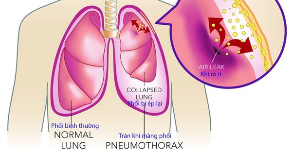 Tràn khí màng phổi là biến chứng cấp tính của các bệnh thường gặp ở phổi