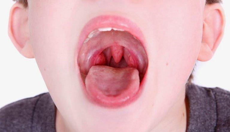 Cách làm tan đờm trong cổ họng là gì?