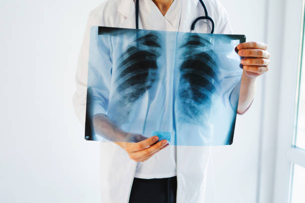 Xquang phổi giúp chẩn đoán COPD