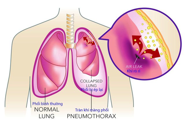 Bệnh lý nào là nguyên nhân tràn khí màng phổi?