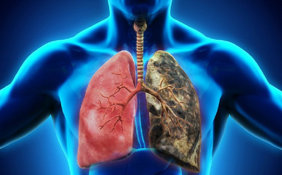 Các loại bụi sẽ gây tổn thương phế quản, phế nang dẫn đến tràn khí màng phổi