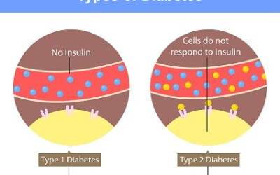 bệnh tiểu đường có 2 loại Tiểu đường type 1 và Tiểu đường type 2