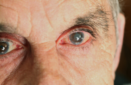 Biến chứng mạch máu nhỏ của bệnh tiểu đường ảnh hưởng đến thị lực của người bệnh