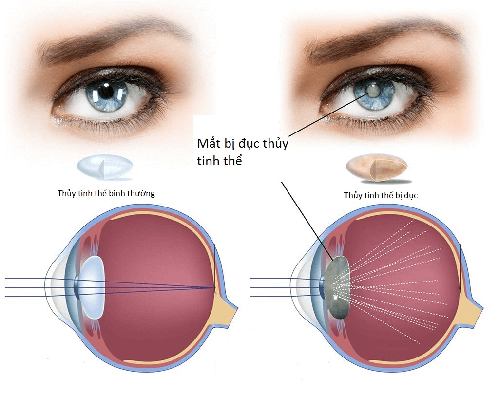 Đục thủy tinh thể - Biến chứng tiểu đường ở mắt