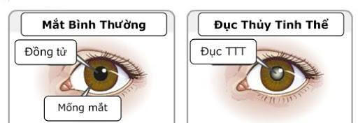 Biến chứng đục thủy tinh thể không điều trị kịp thời sẽ gây mù mắt