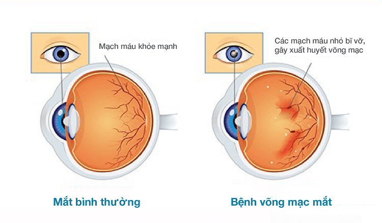 Biến chứng võng mạc mắt có thể gây mù lòa