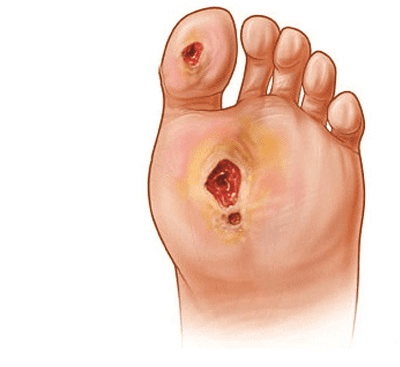 Nguyên nhân gây biến chứng loét bàn chân ở người bệnh tiểu đường là gì?
