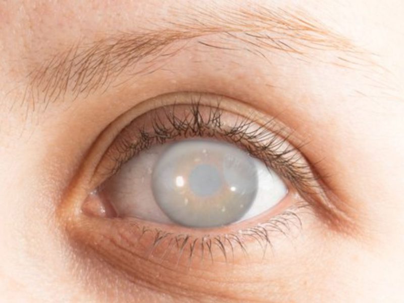 Biến chứng trên mắt có thể khiến người bệnh mù lòa vĩnh viễn