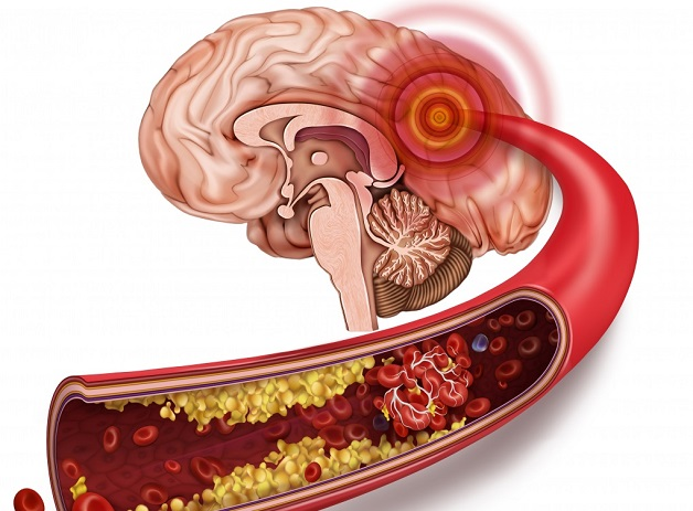 Tìm hiểu mối quan hệ giữa tai biến mạch máu não và bệnh tiểu đường