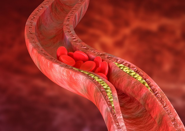 Đường huyết cao có thể làm tăng nguy cơ xơ vữa mạch máu