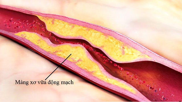 Các mảng xơ vữa hình thành trong lòng mạch máu
