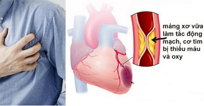 Xơ vữa động mạch vành sẽ gây thiếu máu cơ tim cục bộ