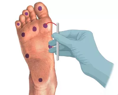 Bài test monofilament giúp đánh giá phản xạ chân của người bệnh tiểu đường